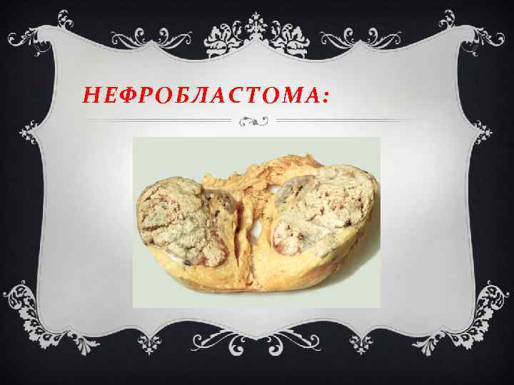 НЕФРОБЛАСТОМА: 