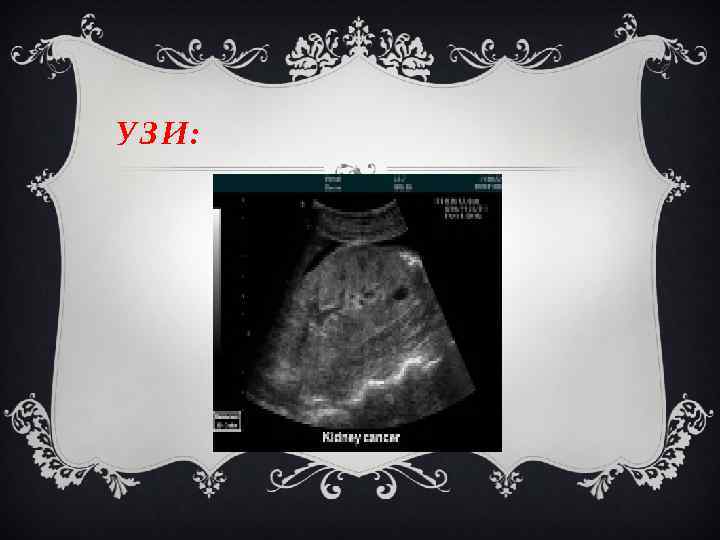 УЗИ: 