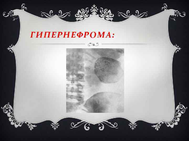 ГИПЕРНЕФРОМА: 