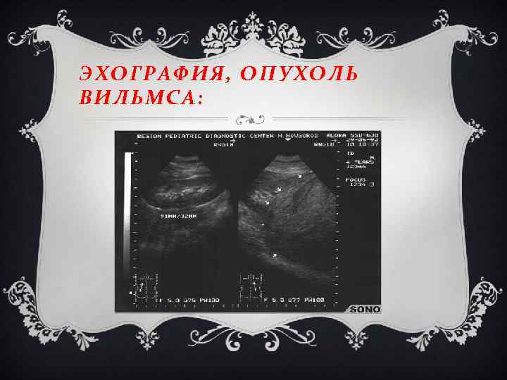 ЭХОГРАФИЯ, ОПУХОЛЬ ВИЛЬМСА: 