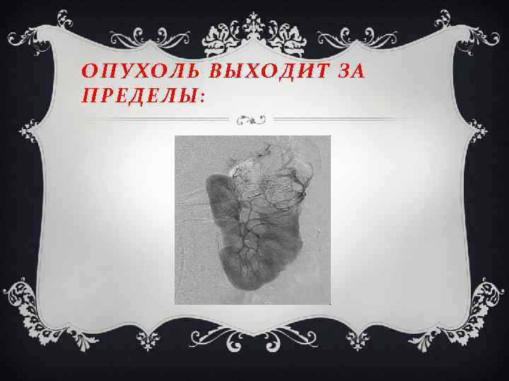 ОПУХОЛЬ ВЫХОДИТ ЗА ПРЕДЕЛЫ: 