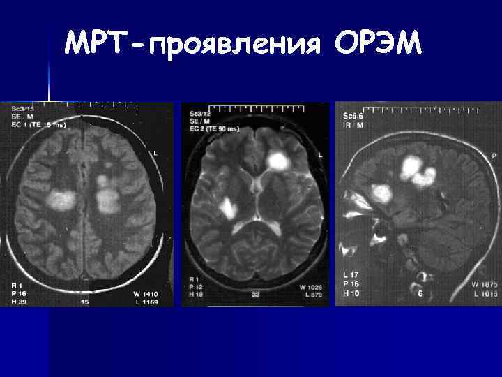 Демиелинизирующие заболевания нервной системы презентация