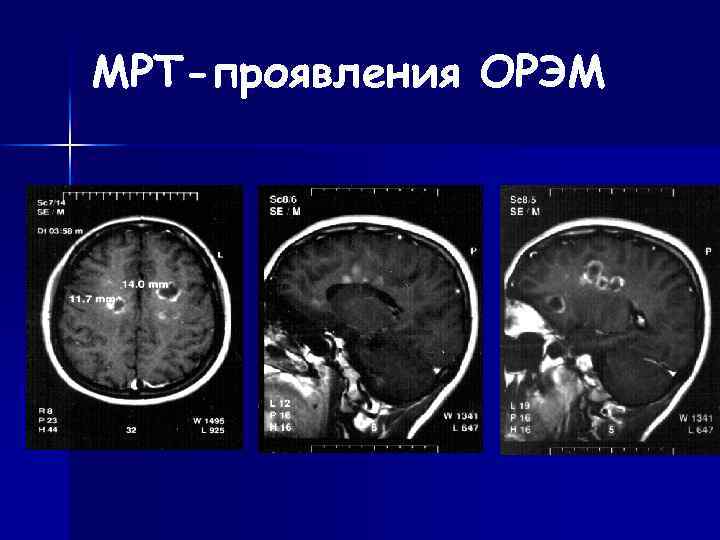 Орэм мрт картина