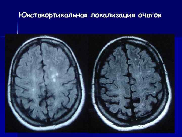 Мр картина единичных очагов глиоза. Инфратенториальные очаги головного мозга. Юкстакортикальные очаги головного мозга. Субкортикальные очаги. Юкстакортикальные очаги мрт.