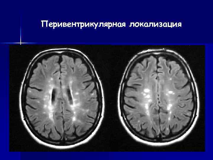 Мр картина перивентрикулярной лейкопатии