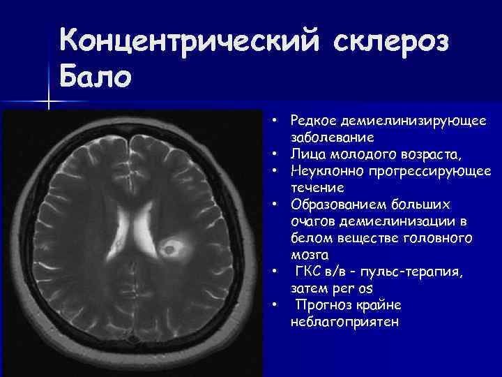 Концентрический склероз Бало • Редкое демиелинизирующее заболевание • Лица молодого возраста, • Неуклонно прогрессирующее