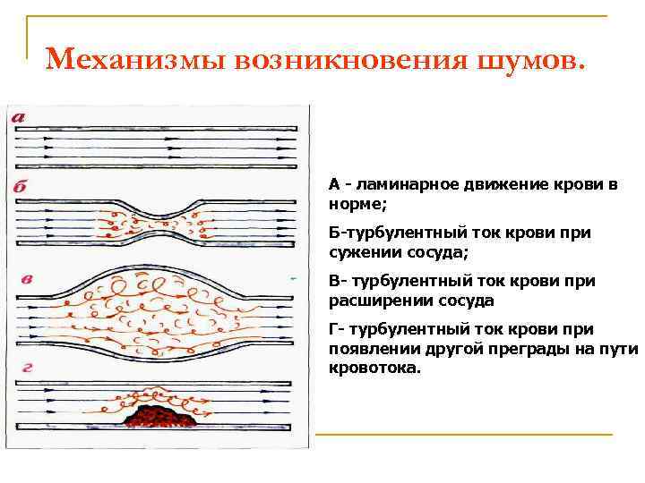Механизмы возникновения шумов. А - ламинарное движение крови в норме; Б-турбулентный ток крови при