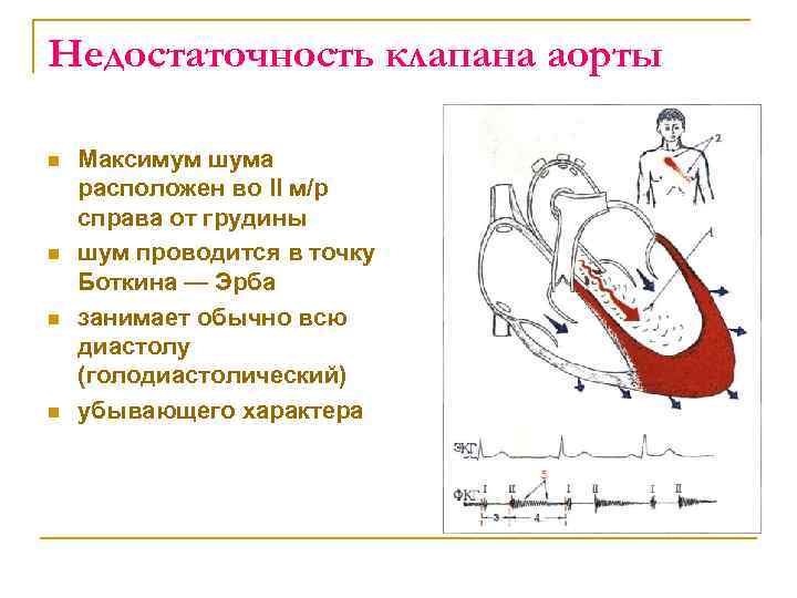 Недостаточность клапана аорты n n Максимум шума расположен во II м/р справа от грудины