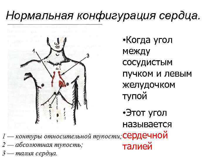 Нормальная конфигурация сердца. • Когда угол между сосудистым пучком и левым желудочком тупой •