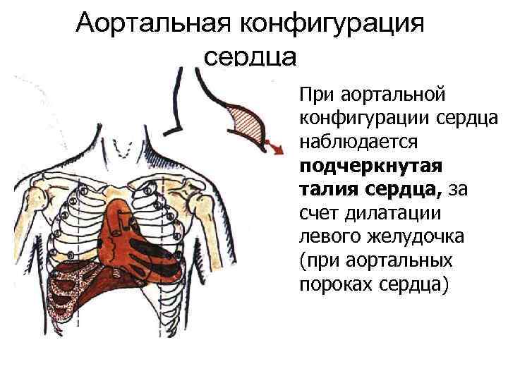 Аортальная конфигурация сердца При аортальной конфигурации сердца наблюдается подчеркнутая талия сердца, за счет дилатации