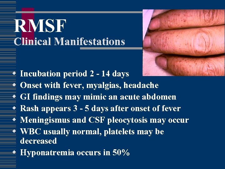 RMSF Clinical Manifestations w w w Incubation period 2 - 14 days Onset with