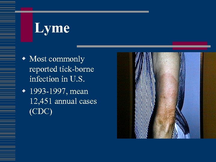 Lyme w Most commonly reported tick-borne infection in U. S. w 1993 -1997, mean