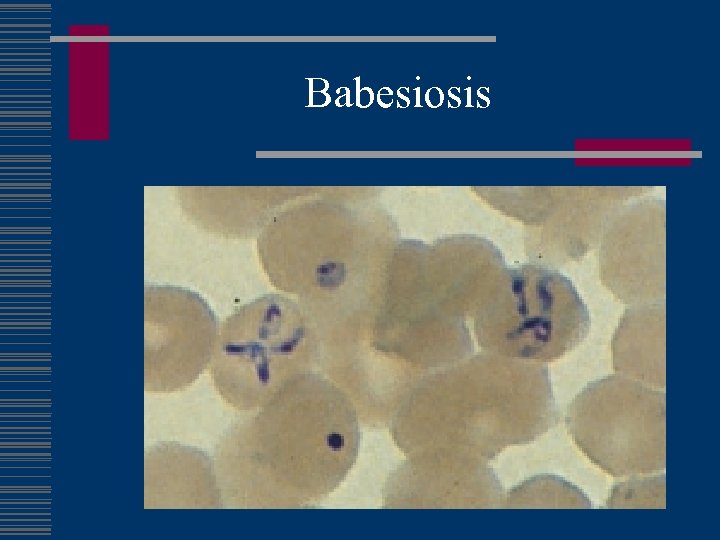 Babesiosis 