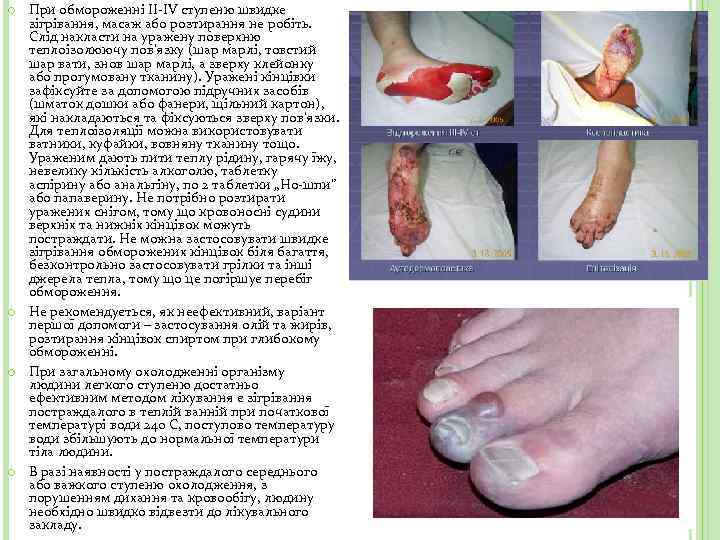  При обмороженні II-IV ступеню швидке зігрівання, масаж або розтирання не робіть. Слід накласти