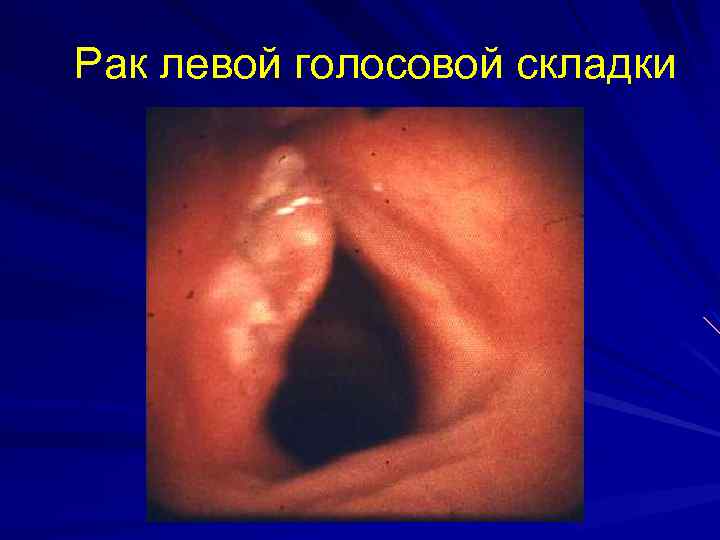  Рак левой голосовой складки 