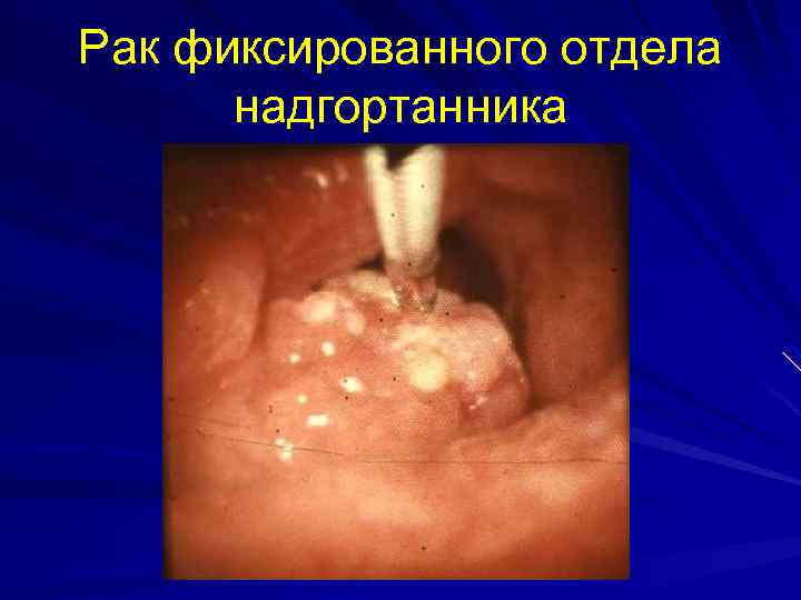 Рак фиксированного отдела надгортанника 