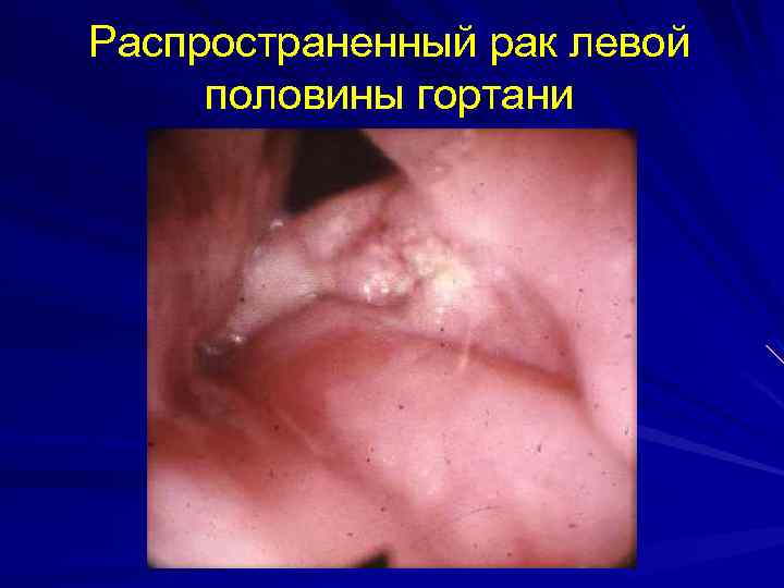 Распространенный рак левой половины гортани 