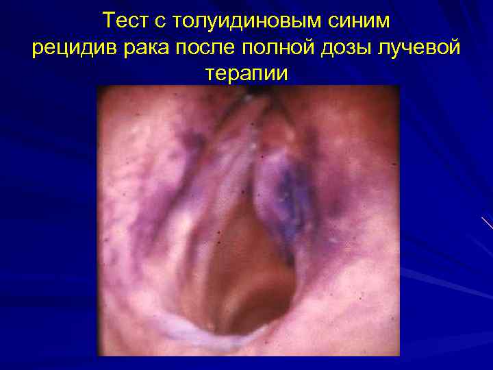 Тест с толуидиновым синим рецидив рака после полной дозы лучевой терапии 