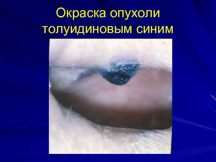 Окраска опухоли толуидиновым синим 