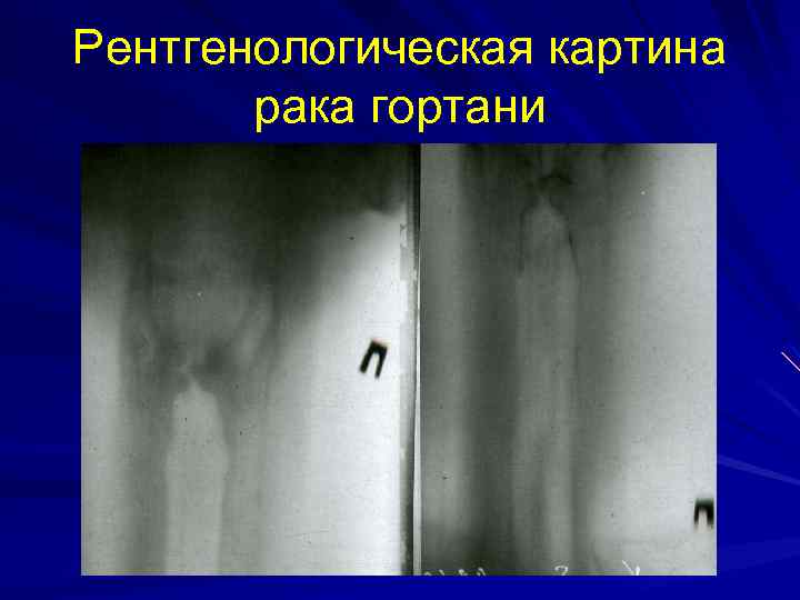 Рентгенологическая картина рака гортани 