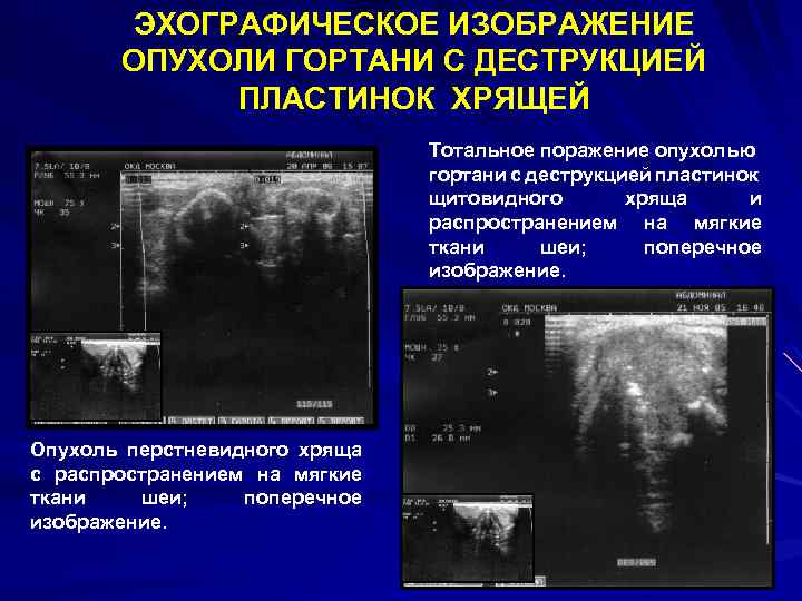 Эхографическое изображение злокачественной опухоли чаще представляет собой образование