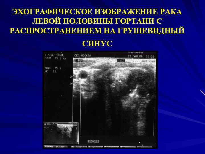 ЭХОГРАФИЧЕСКОЕ ИЗОБРАЖЕНИЕ РАКА ЛЕВОЙ ПОЛОВИНЫ ГОРТАНИ С РАСПРОСТРАНЕНИЕМ НА ГРУШЕВИДНЫЙ СИНУС 