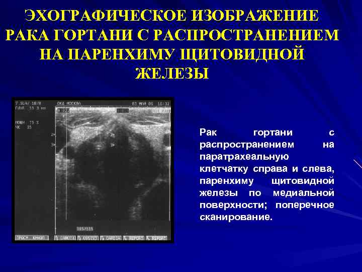 Эхографическая картина неизмененной аорты при поперечном сканировании тест