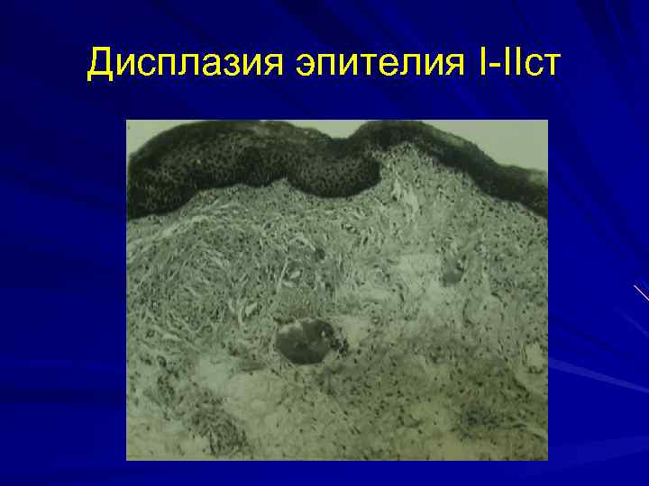 Дисплазия эпителия I-IIст 