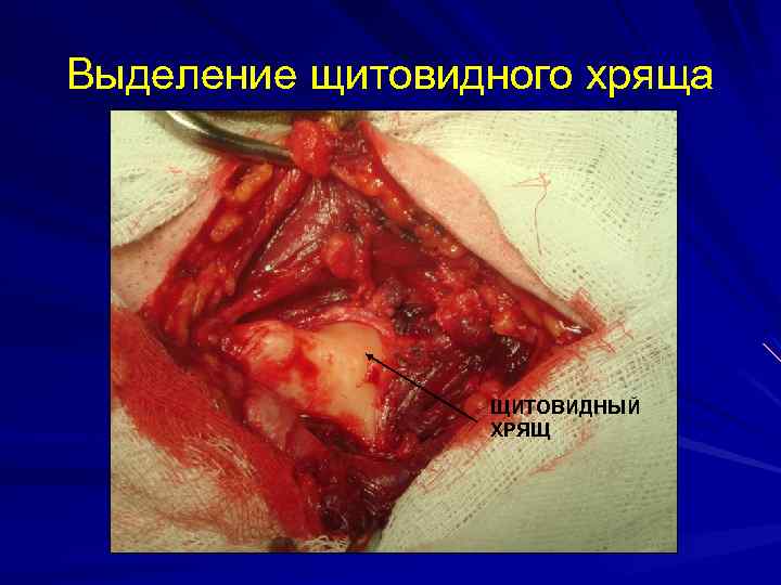 Выделение щитовидного хряща ЩИТОВИДНЫЙ ХРЯЩ 
