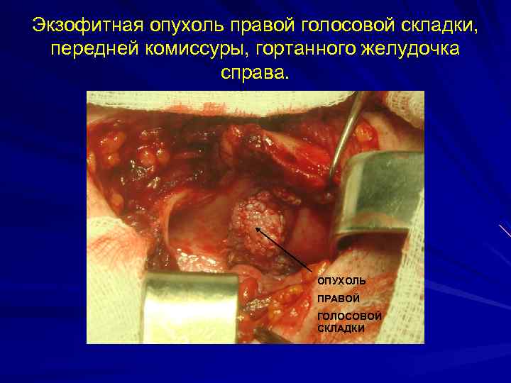 Экзофитная опухоль правой голосовой складки, передней комиссуры, гортанного желудочка справа. ОПУХОЛЬ ПРАВОЙ ГОЛОСОВОЙ СКЛАДКИ