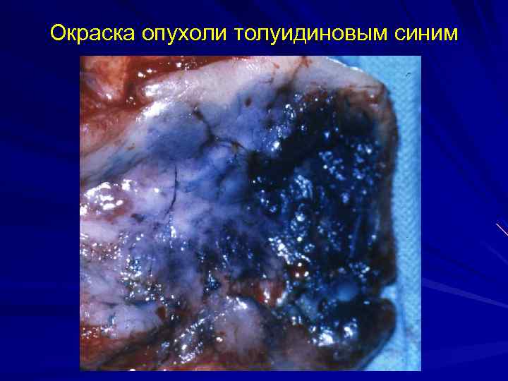 Окраска опухоли толуидиновым синим 