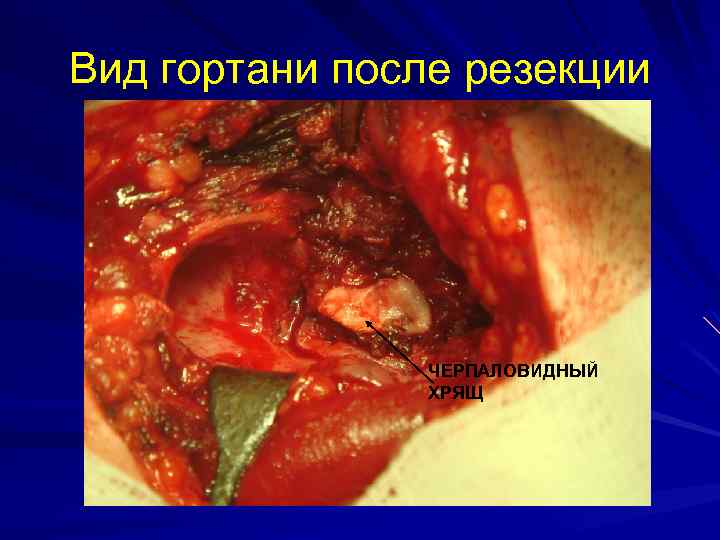 Вид гортани после резекции ЧЕРПАЛОВИДНЫЙ ХРЯЩ 