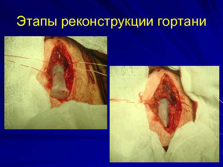 Этапы реконструкции гортани 