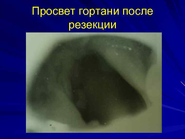 Просвет гортани после резекции 