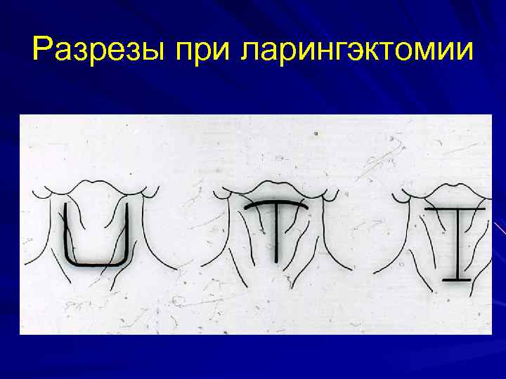 Разрезы при ларингэктомии 