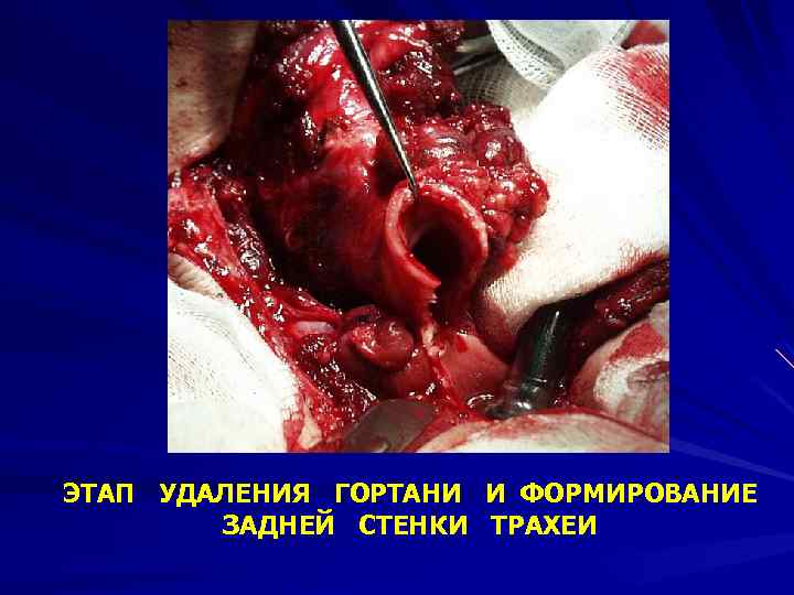 ЭТАП УДАЛЕНИЯ ГОРТАНИ И ФОРМИРОВАНИЕ ЗАДНЕЙ СТЕНКИ ТРАХЕИ 