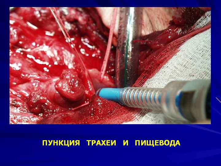 ПУНКЦИЯ ТРАХЕИ И ПИЩЕВОДА 