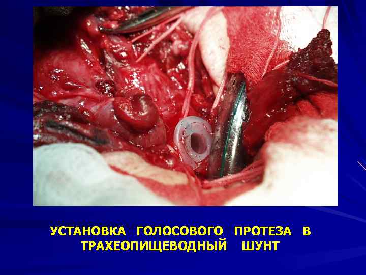 УСТАНОВКА ГОЛОСОВОГО ПРОТЕЗА В ТРАХЕОПИЩЕВОДНЫЙ ШУНТ 
