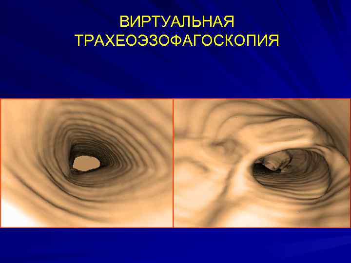 ВИРТУАЛЬНАЯ ТРАХЕОЭЗОФАГОСКОПИЯ 