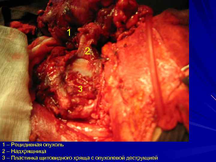 1 2 3 1 – Рецидивная опухоль 2 – Надхрящница 3 – Пластинка щитовидного