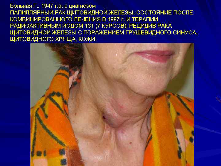 Больная Г. , 1947 г. р. с диагнозом ПАПИЛЛЯРНЫЙ РАК ЩИТОВИДНОЙ ЖЕЛЕЗЫ. СОСТОЯНИЕ ПОСЛЕ