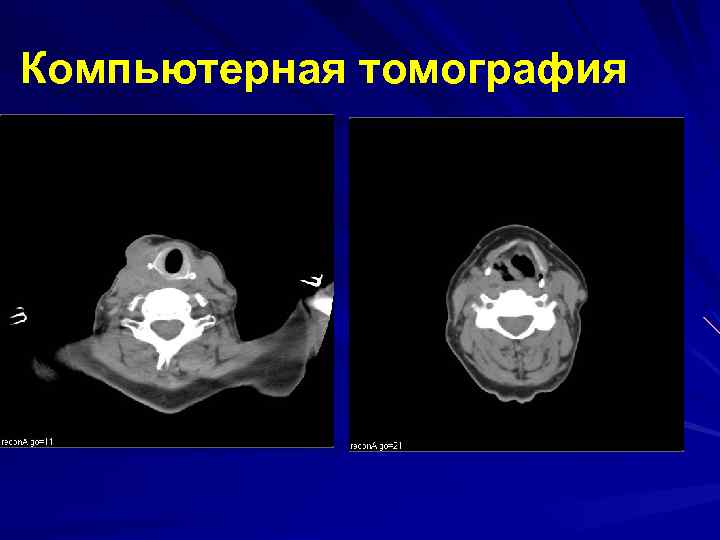 Компьютерная томография 