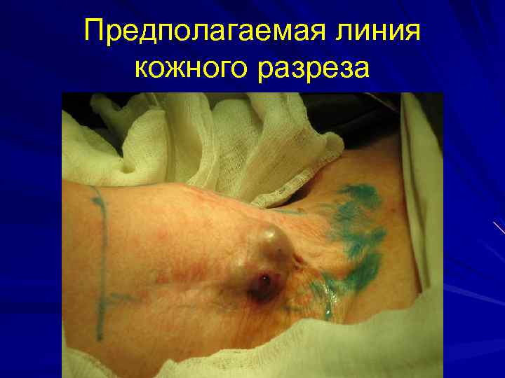 Предполагаемая линия кожного разреза 