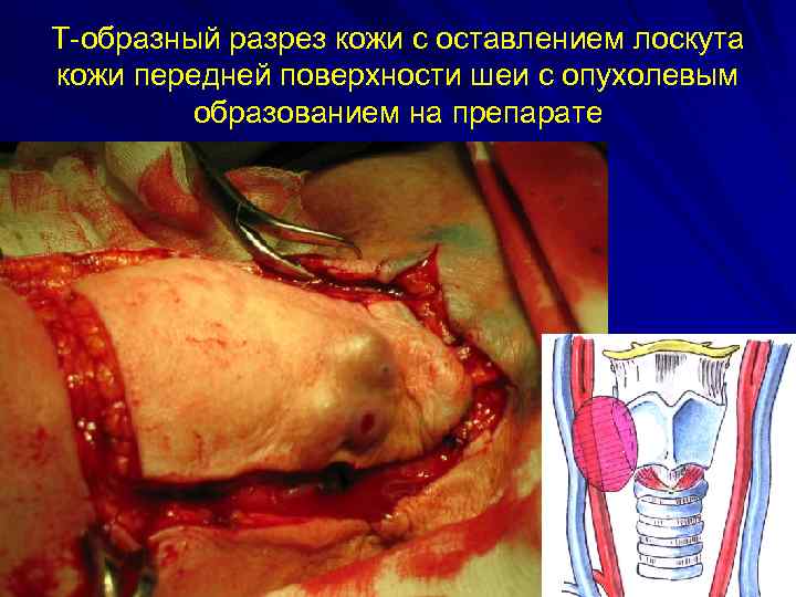 Т-образный разрез кожи с оставлением лоскута кожи передней поверхности шеи с опухолевым образованием на