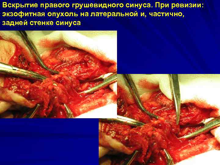 Вскрытие правого грушевидного синуса. При ревизии: экзофитная опухоль на латеральной и, частично, задней стенке
