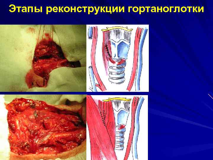 Этапы реконструкции гортаноглотки 