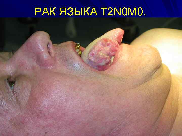 РАК ЯЗЫКА Т 2 N 0 M 0. 