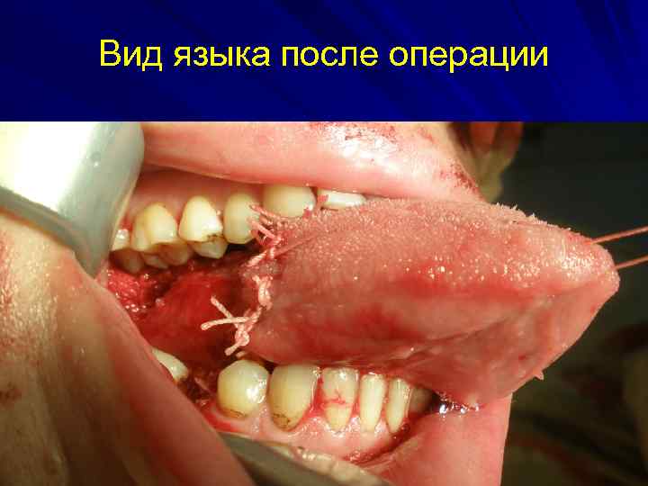 Вид языка после операции 