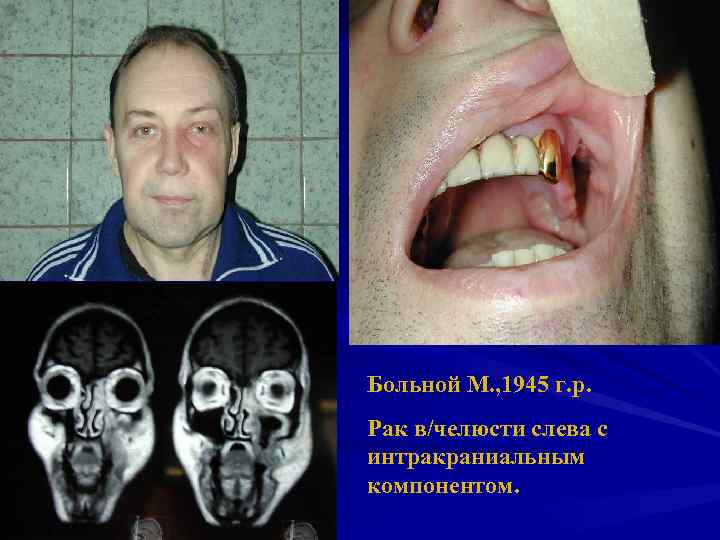 Больной М. , 1945 г. р. Рак в/челюсти слева с интракраниальным компонентом. 
