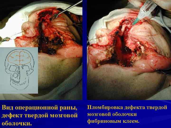 Вид операционной раны, дефект твердой мозговой оболочки. Пломбировка дефекта твердой мозговой оболочки фибриновым клеем.